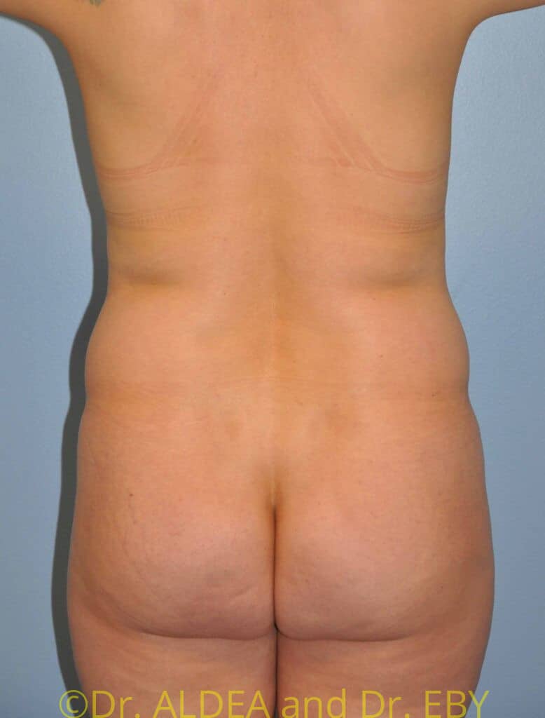 Before Image: Tummy Tuck #780 - back