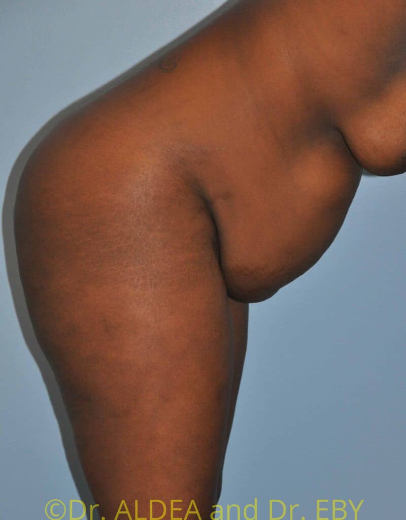 Before Image: Tummy Tuck #875 - other