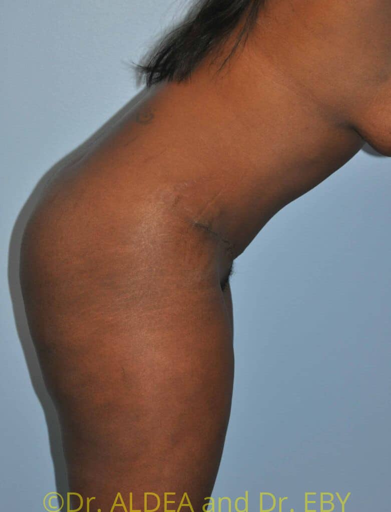 After Image: Tummy Tuck #875 - other
