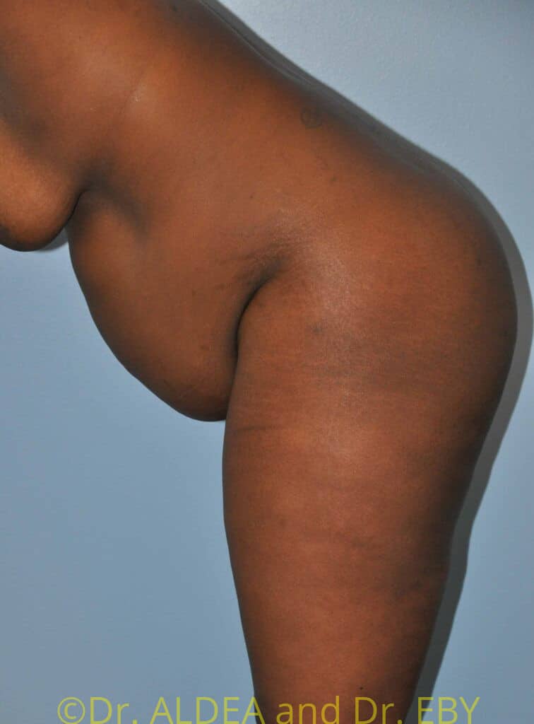 Before Image: Tummy Tuck #875 - other