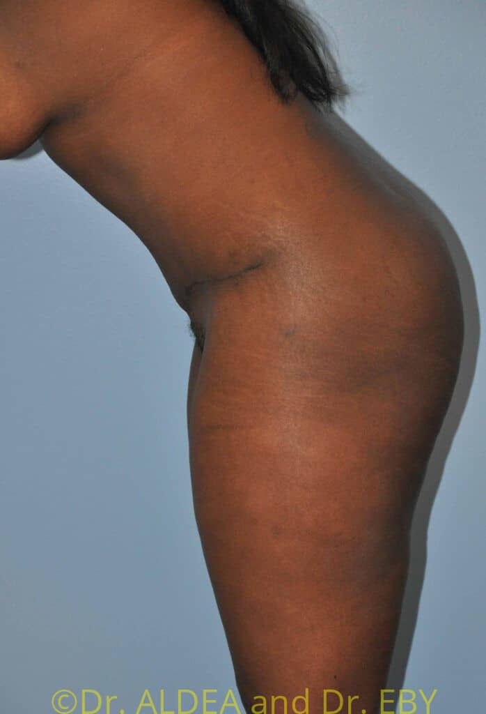 After Image: Tummy Tuck #875 - other