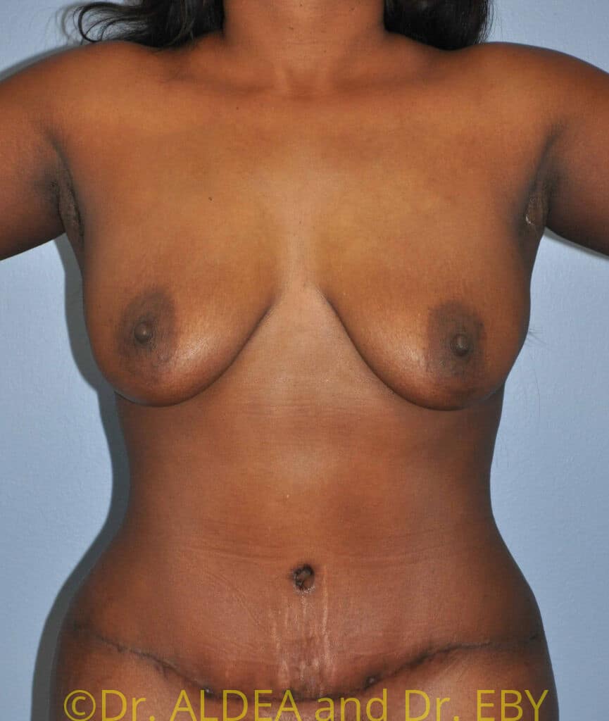 After Image: Tummy Tuck #875 - front