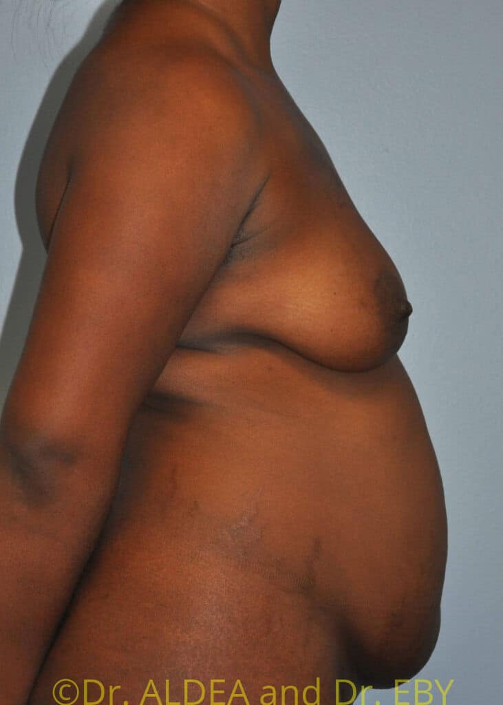 Before Image: Tummy Tuck #875 - right-side