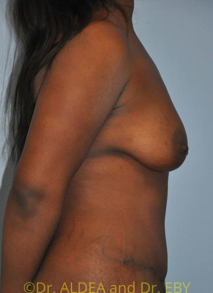 After Image: Tummy Tuck #875 - right-side