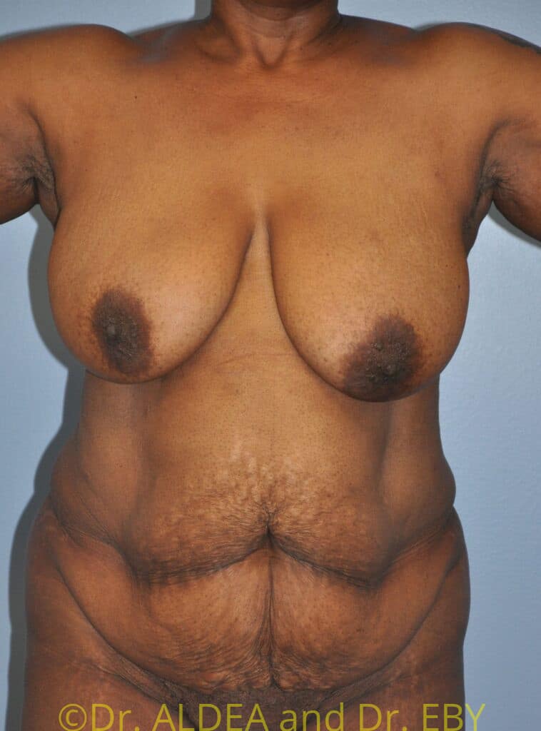 Before Image: Tummy Tuck #658 - front