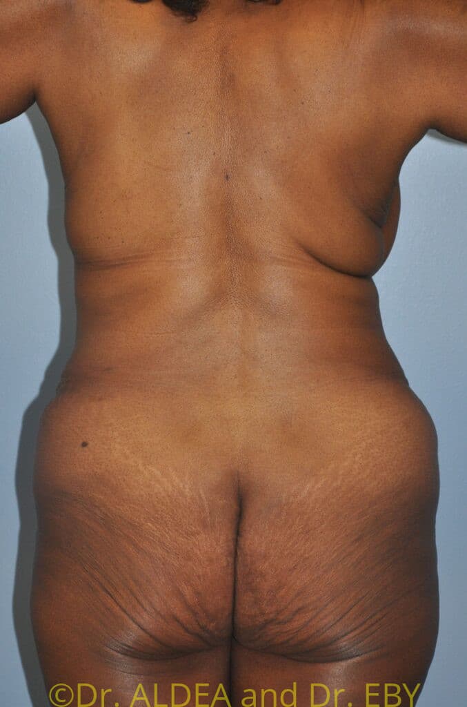 After Image: Tummy Tuck #658 - back