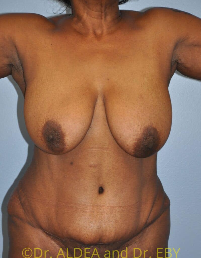After Image: Tummy Tuck #658 - front