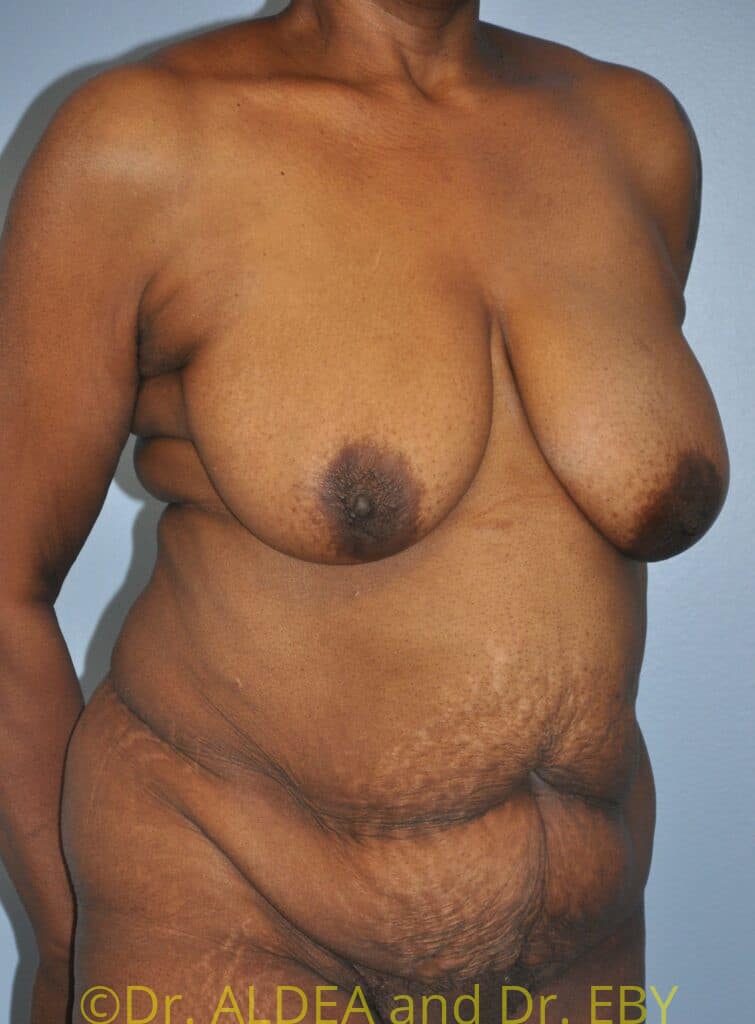 Before Image: Tummy Tuck #658 - right-front-oblique