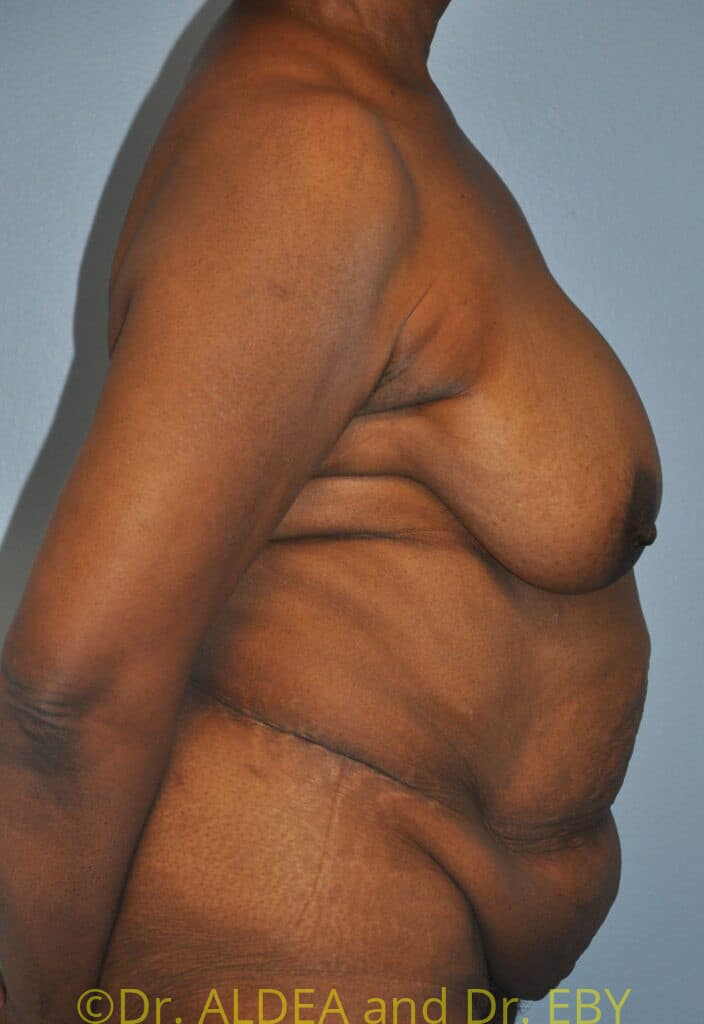 Before Image: Tummy Tuck #658 - right-side