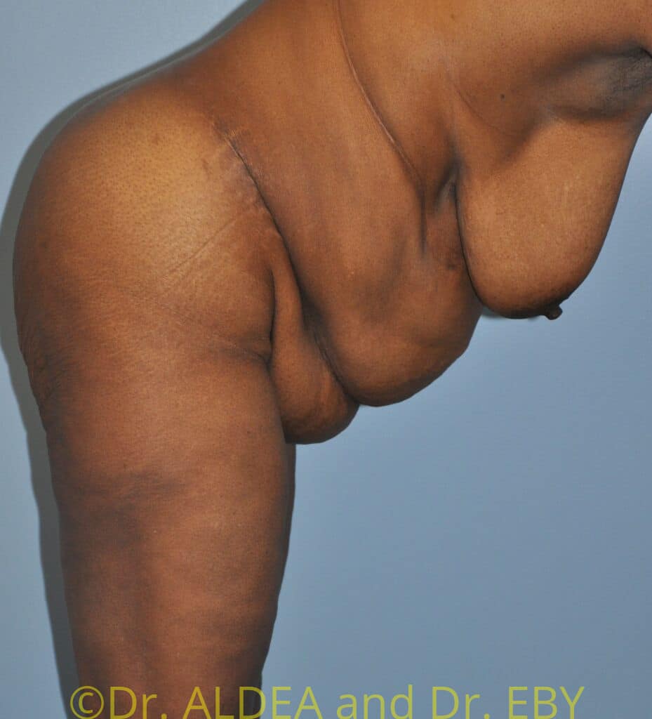 Before Image: Tummy Tuck #658 - other