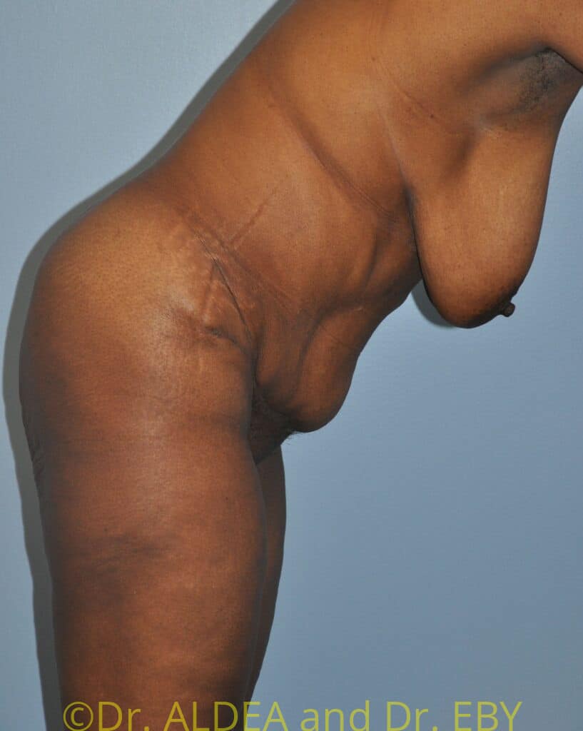 After Image: Tummy Tuck #658 - other