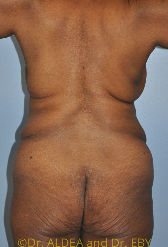 Before Image: Tummy Tuck #658 - back