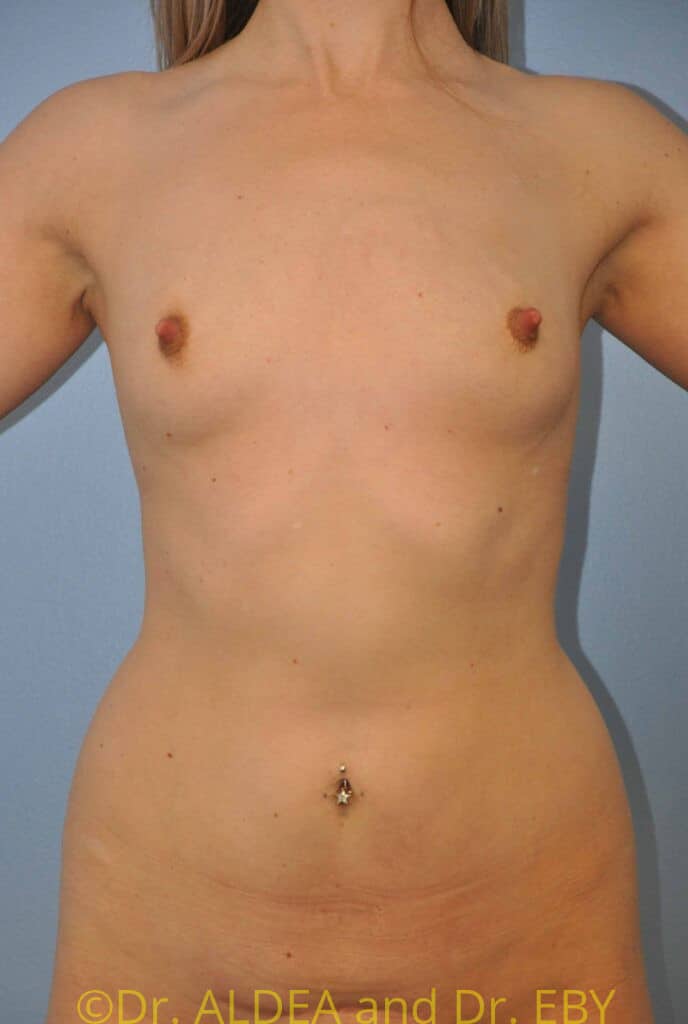 Before Image: Breast Augmentation #633 - front