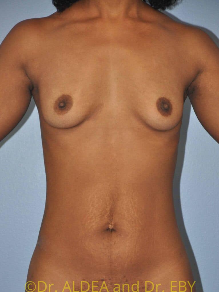 Before Image: Breast Augmentation #722 - front