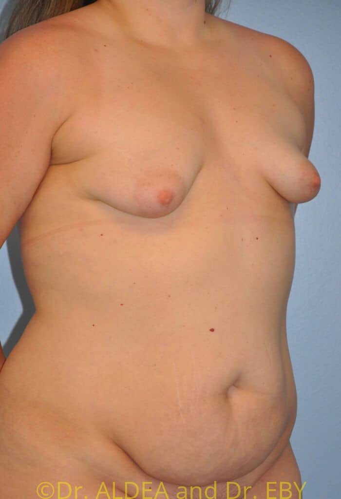 Before Image: Breast Augmentation #807 - right-front-oblique