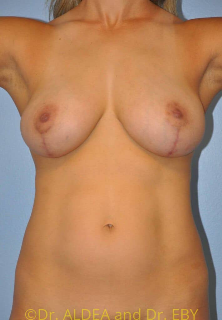 After Image: Breast Augmentation w/ Lift #945 - front