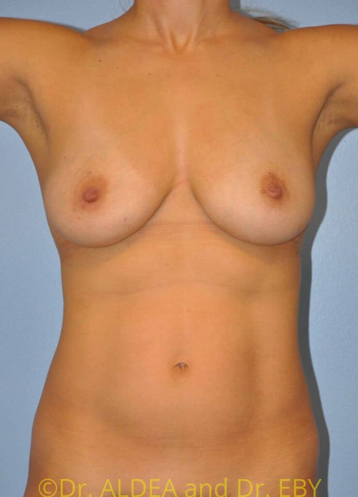 Before Image: Breast Augmentation w/ Lift #945 - front