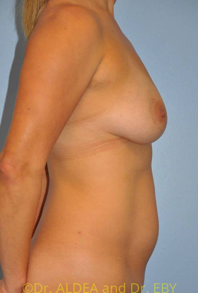 Before Image: Breast Augmentation w/ Lift #945 - right-side