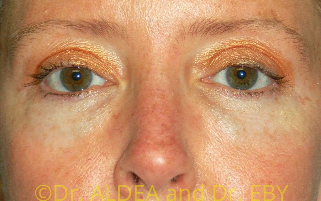 After Image: Blepharoplasty #775 - front
