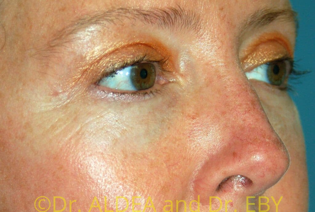 After Image: Blepharoplasty #775 - right-front-oblique