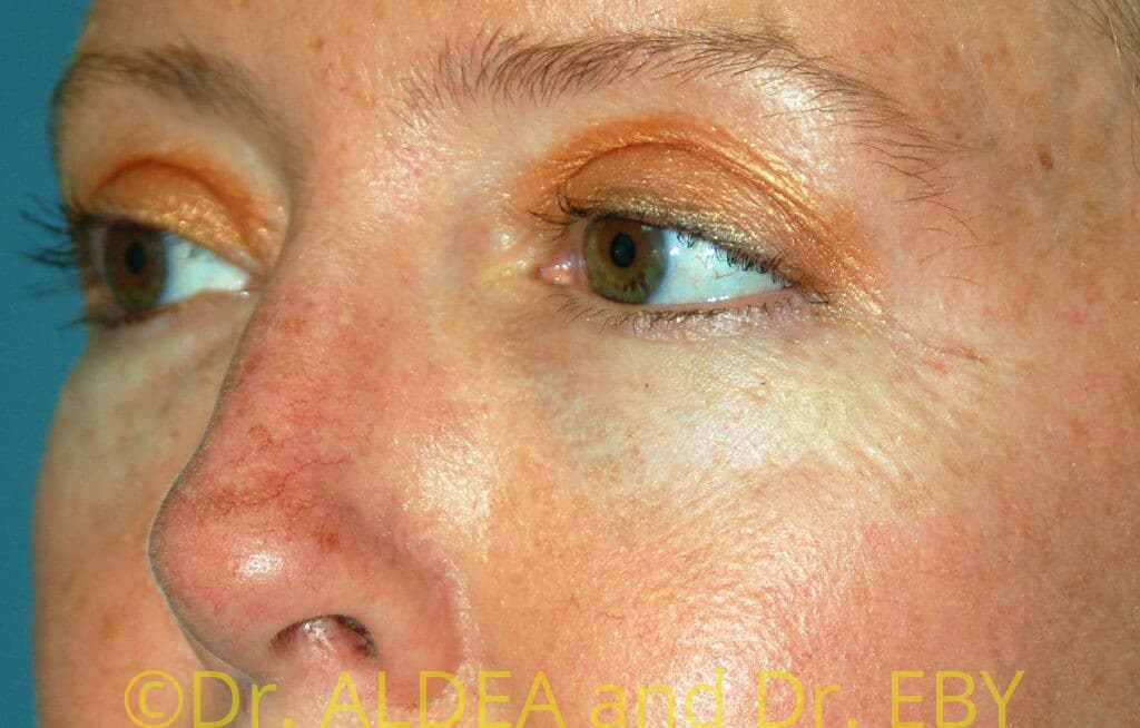 After Image: Blepharoplasty #775 - left-front-oblique