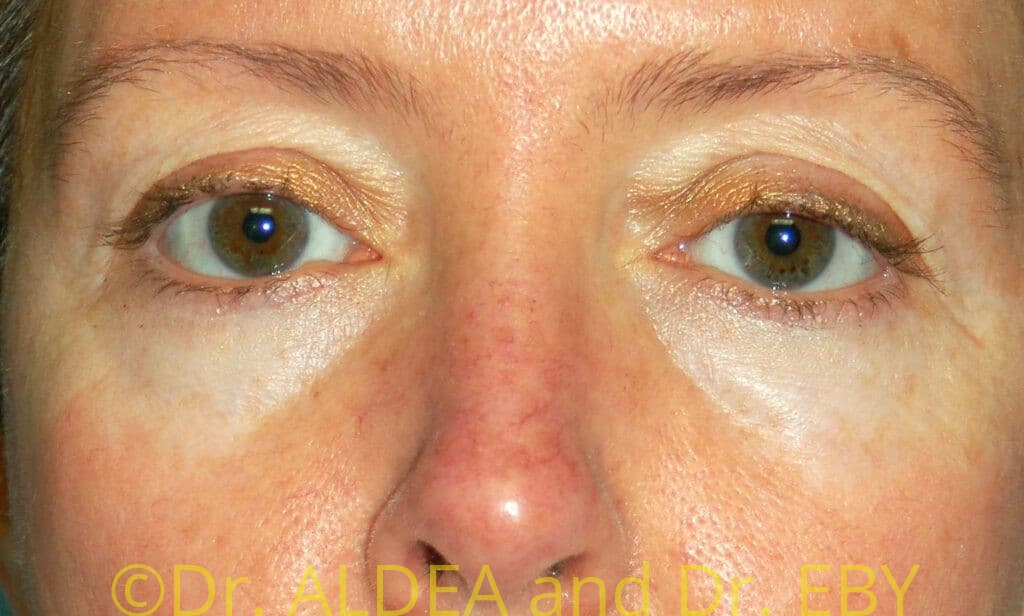 Before Image: Blepharoplasty #775 - front