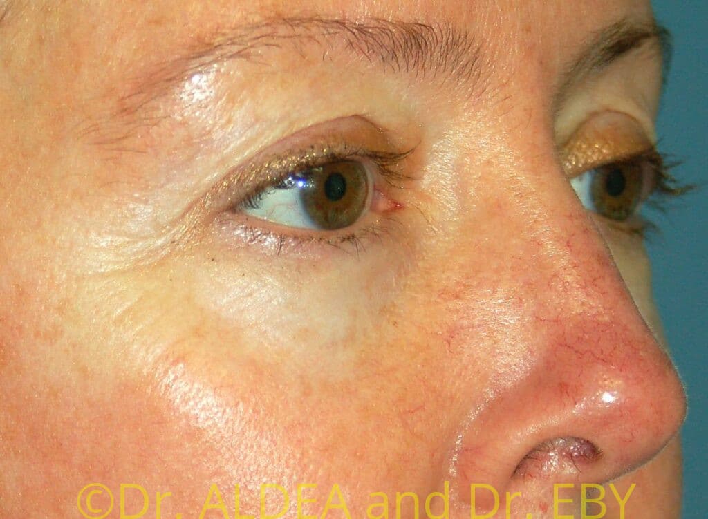 Before Image: Blepharoplasty #775 - right-front-oblique
