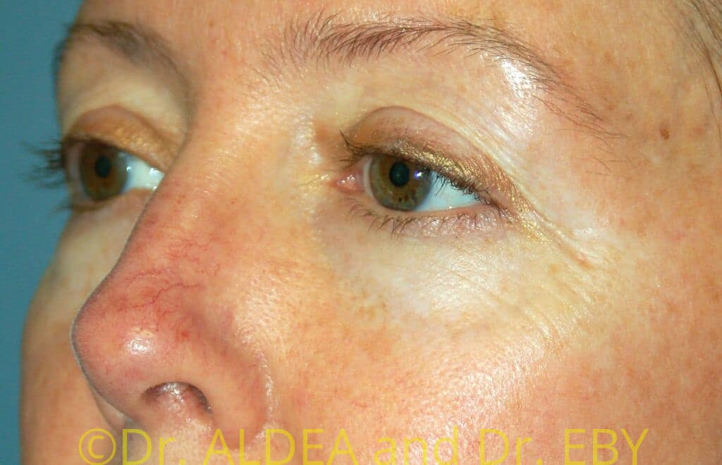 Before Image: Blepharoplasty #775 - left-front-oblique