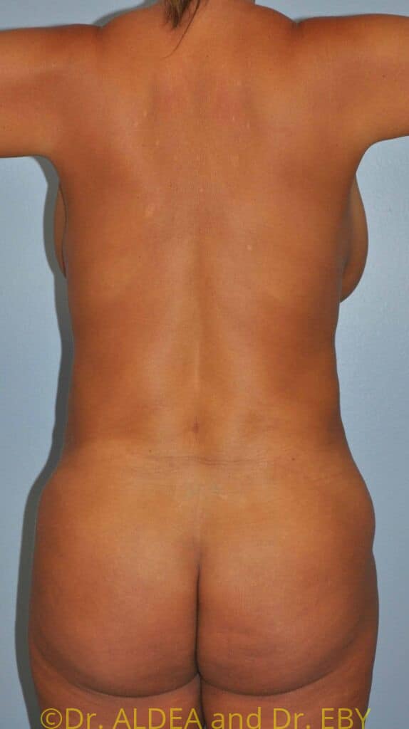 After Image: Back Scoop Liposuction #808 - back