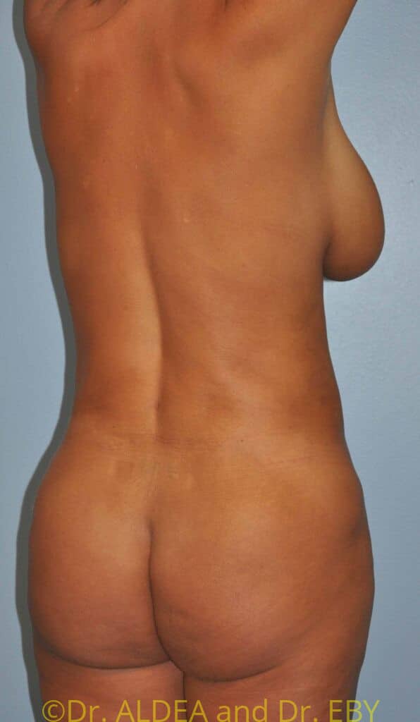 After Image: Back Scoop Liposuction #808 - right-back-oblique
