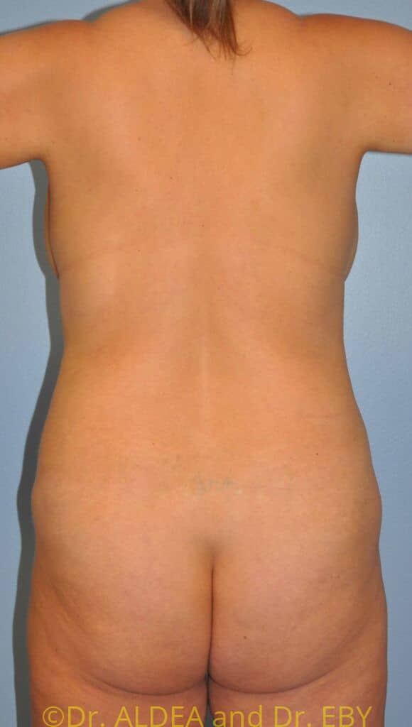 Before Image: Back Scoop Liposuction #808 - back