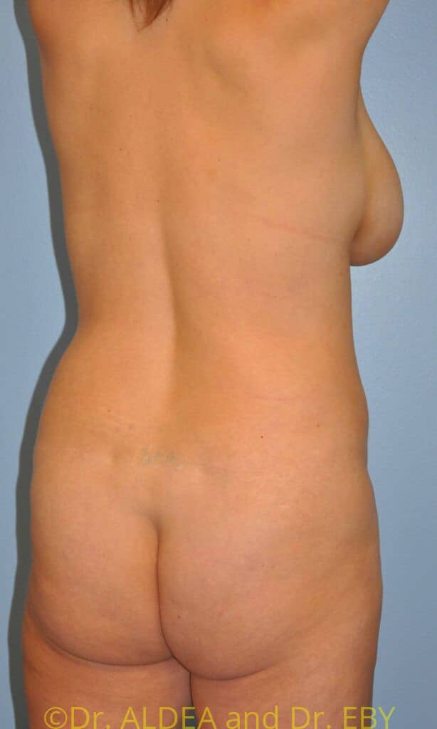 Before Image: Back Scoop Liposuction #808 - right-back-oblique