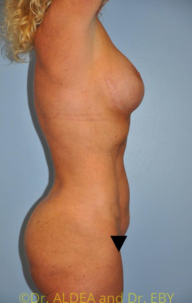 After Image: Precision BBL #181 - right-side