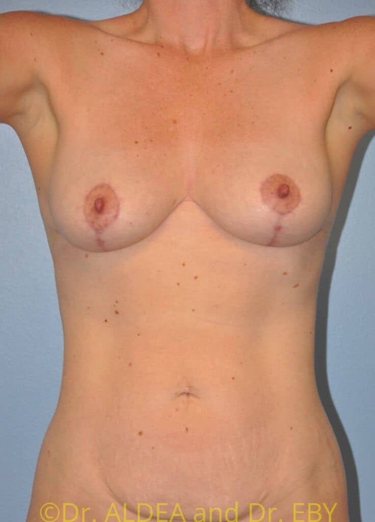 After Image: Short Scar Breast Lift (Mastopexy) #538 - front
