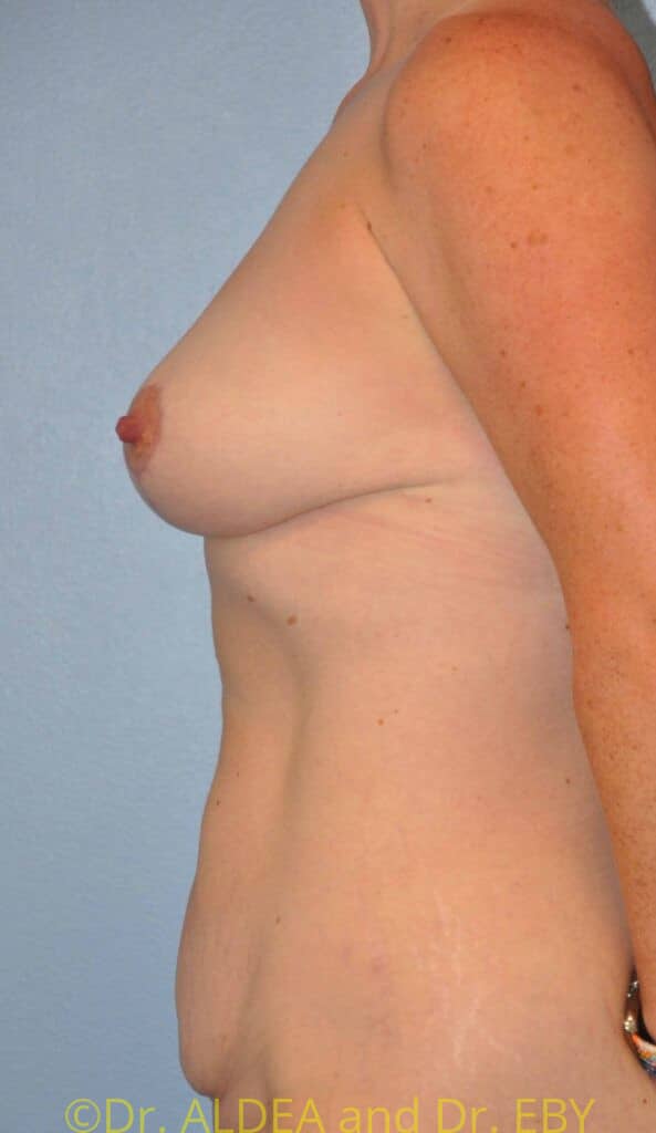 After Image: Short Scar Breast Lift (Mastopexy) #538 - left-side
