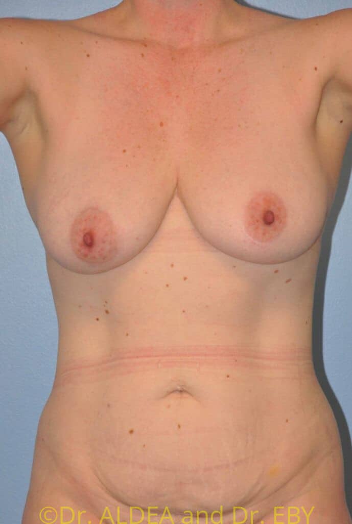 Before Image: Short Scar Breast Lift (Mastopexy) #538 - front