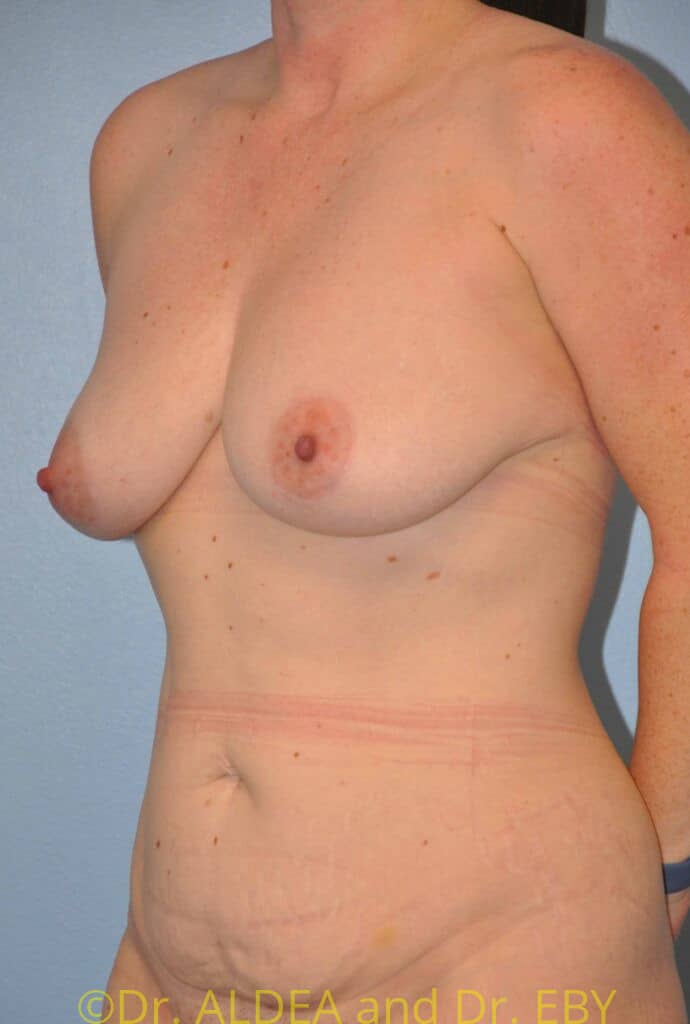 Before Image: Short Scar Breast Lift (Mastopexy) #538 - left-front-oblique