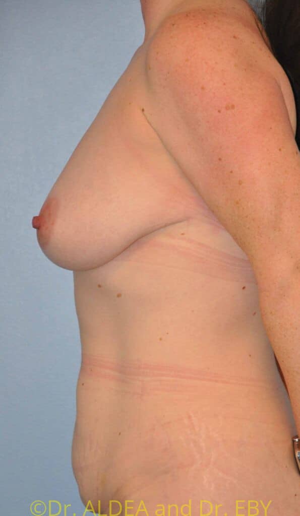 Before Image: Short Scar Breast Lift (Mastopexy) #538 - left-side