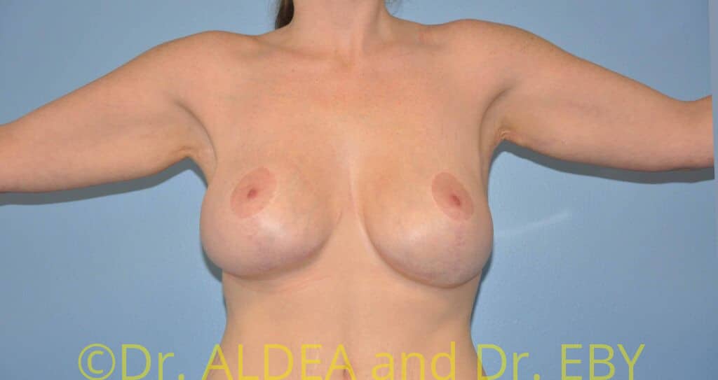Before Image: Brachioplasty #939 - front