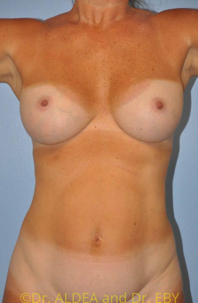 Before Image: Breast Implant Removal (Explantation) WITH a Lift #509 - front