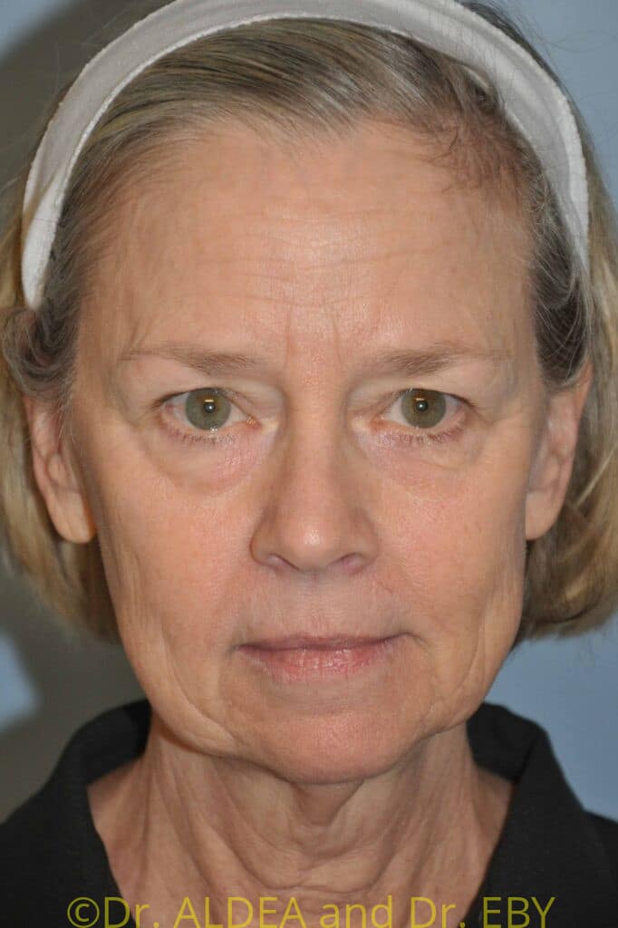Before Image: Facelift #049 - front