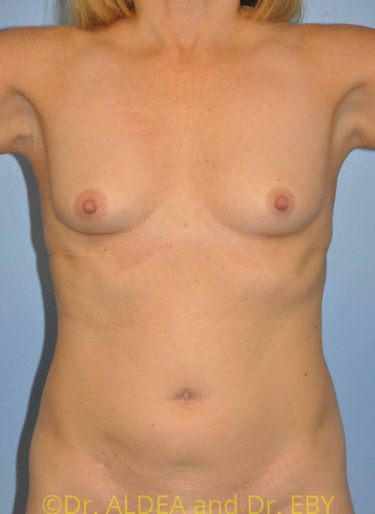 Before Image: Fat Transfer to Breasts #553 - front