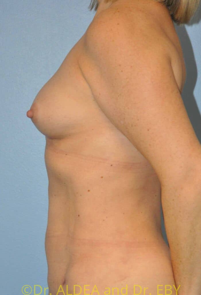 After Image: Fat Transfer to Breasts #553 - left-side