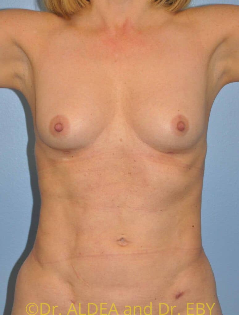 After Image: Fat Transfer to Breasts #553 - front