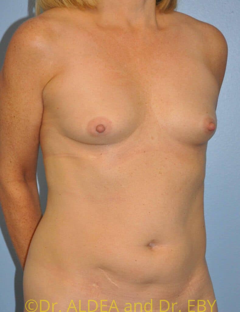 Before Image: Fat Transfer to Breasts #553 - right-front-oblique