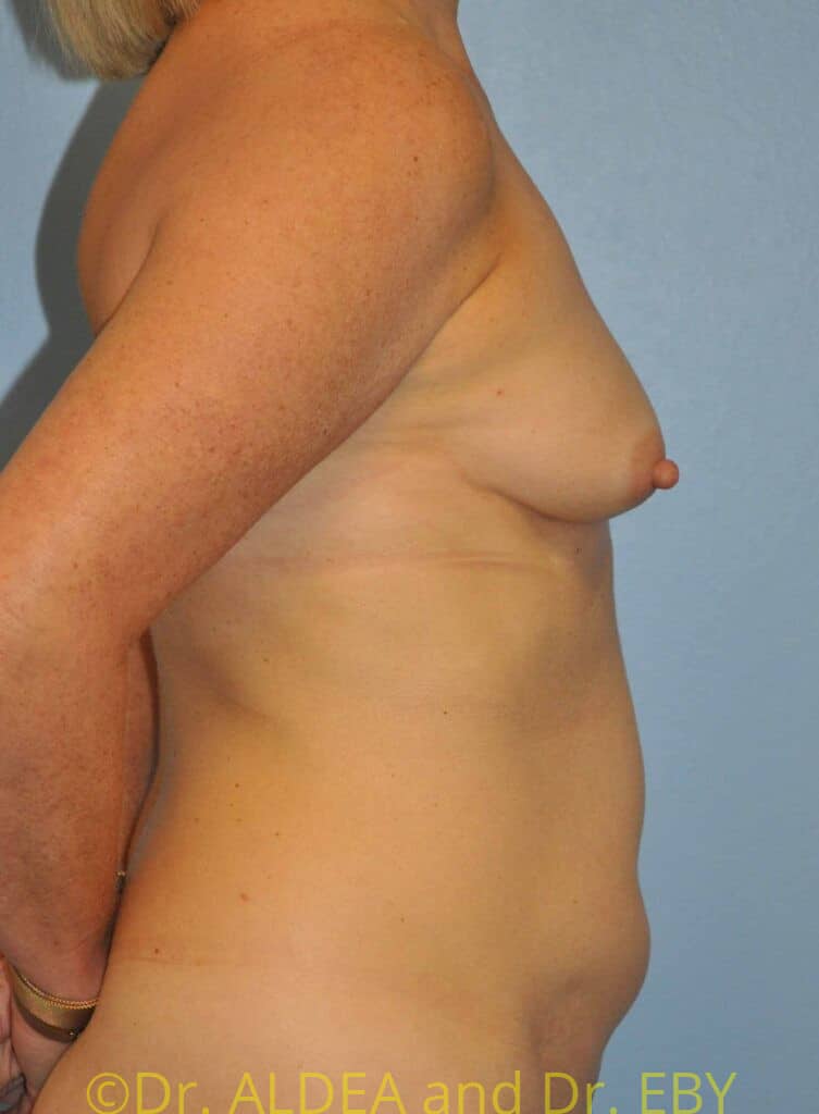 Before Image: Fat Transfer to Breasts #553 - right-side