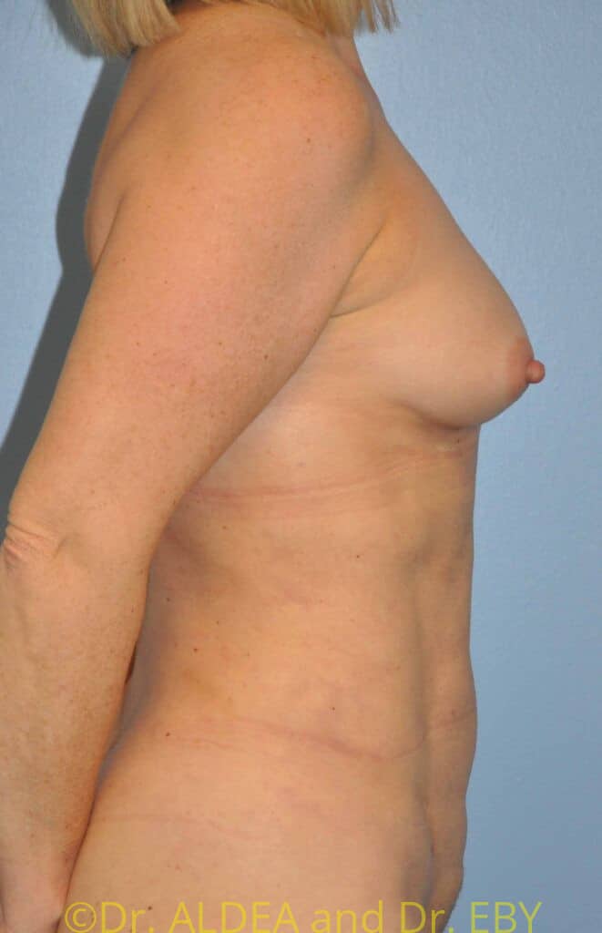 After Image: Fat Transfer to Breasts #553 - right-side
