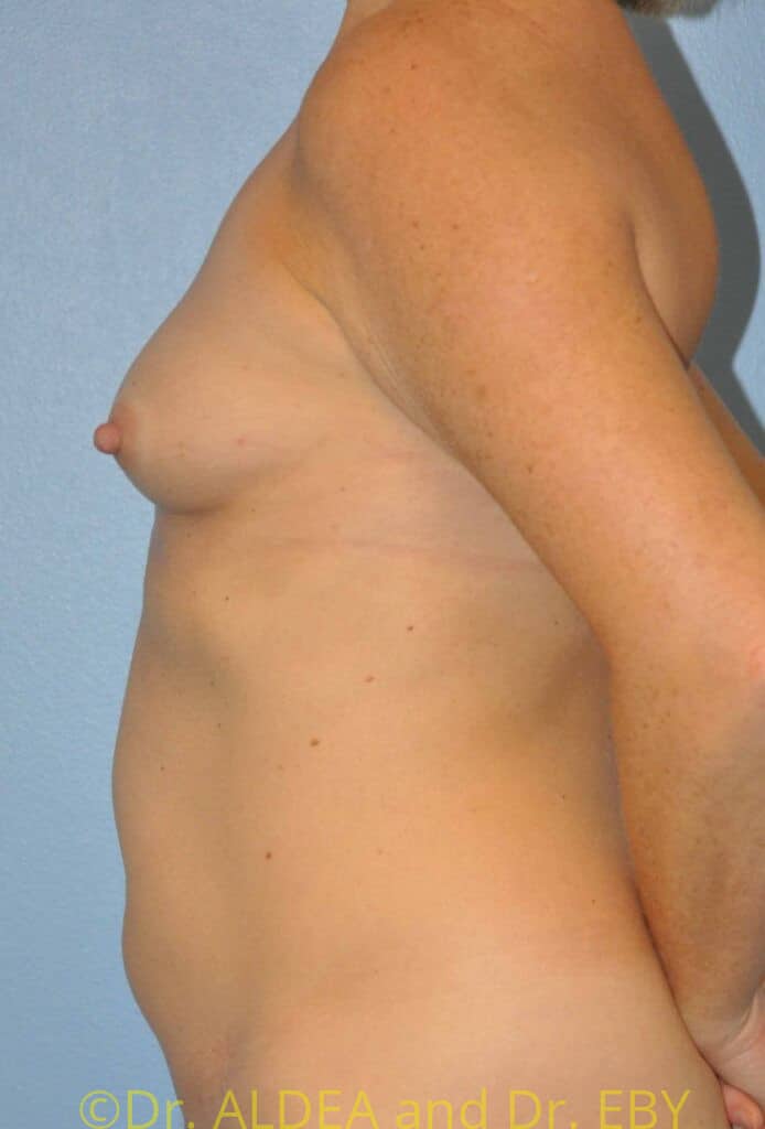 Before Image: Fat Transfer to Breasts #553 - left-side