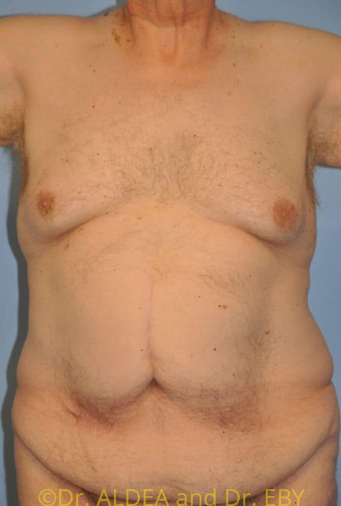 Before Image: Gynecomastia #716 - front