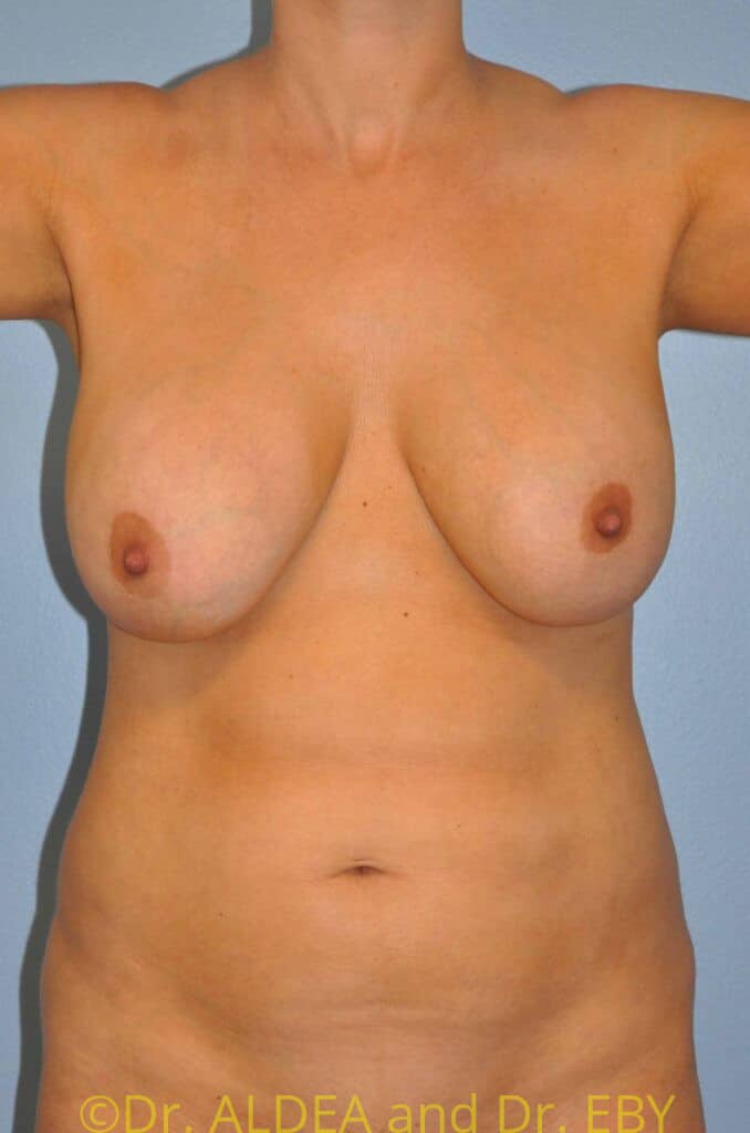 Before Image: Liposuction #808 - front